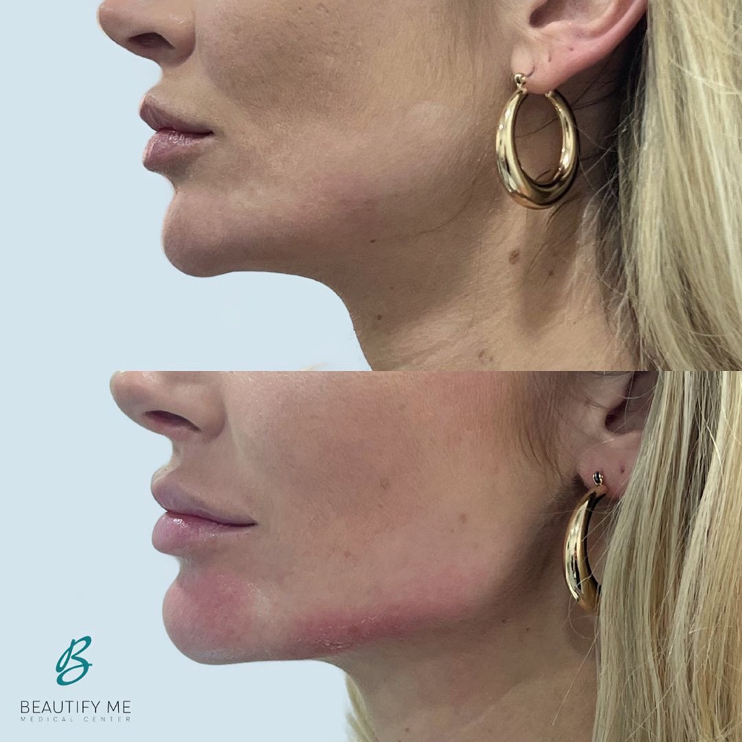 best jawline treatment in dubai , non surgical
