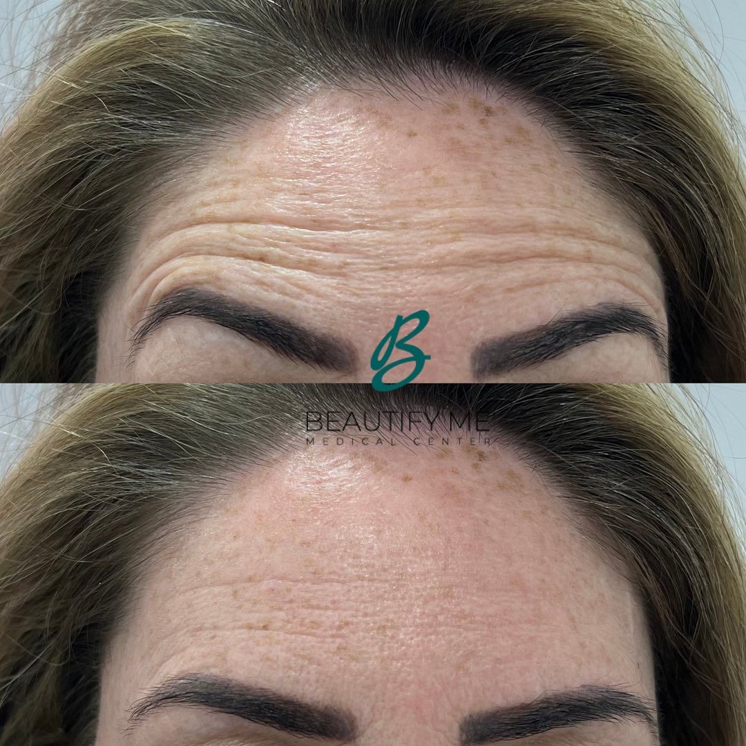 best forehead botox in dubai transformation