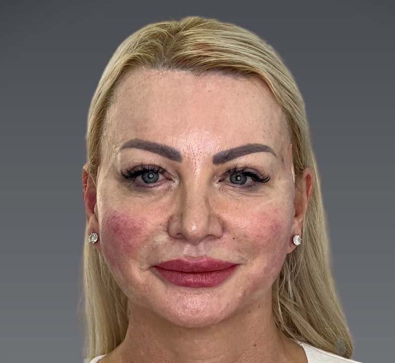 best threads in dubai , non surgical facelift